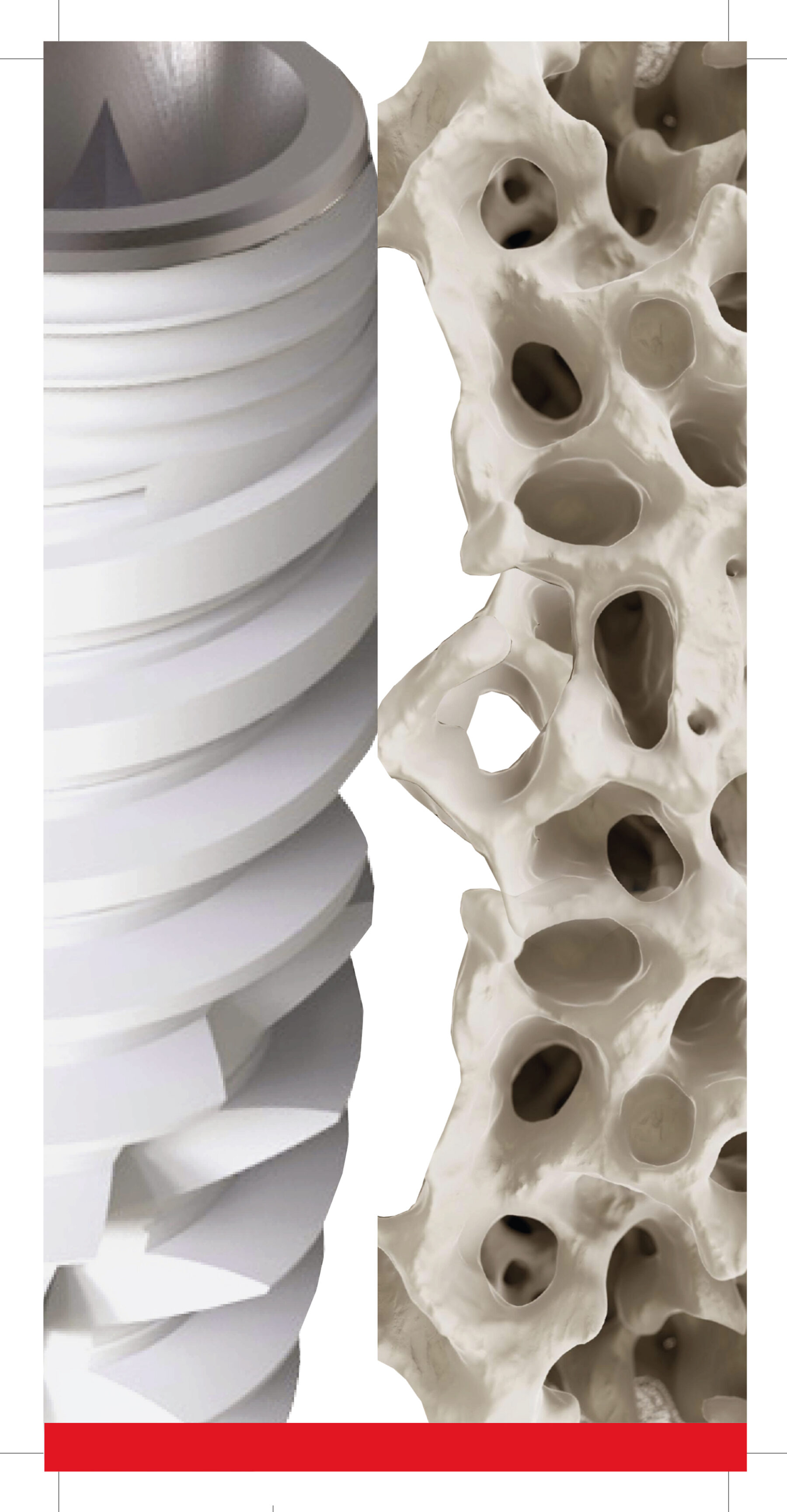 Titanium dental implant beside trabecular bone structure
